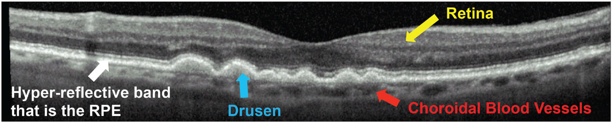 Fig. 1. Teach your patient the retina basics. Show them imaging of their retina to help them understand their disease.