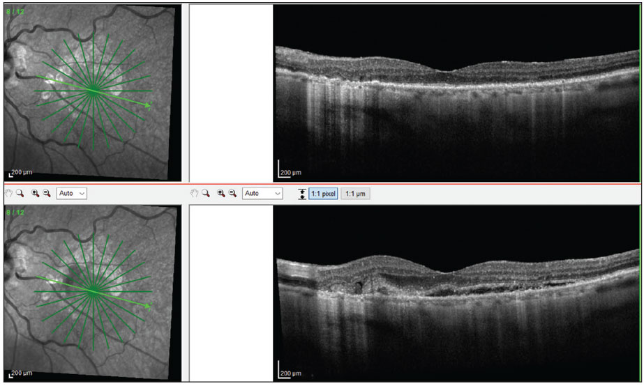 Fig. 4. A patient with advanced dry AMD was seen with 20/20 OS. Less than three weeks later, the patient self reported visual changes and was brought into the clinic. OCT confirmed conversion to wet AMD OS and 20/25 vision (bottom). 