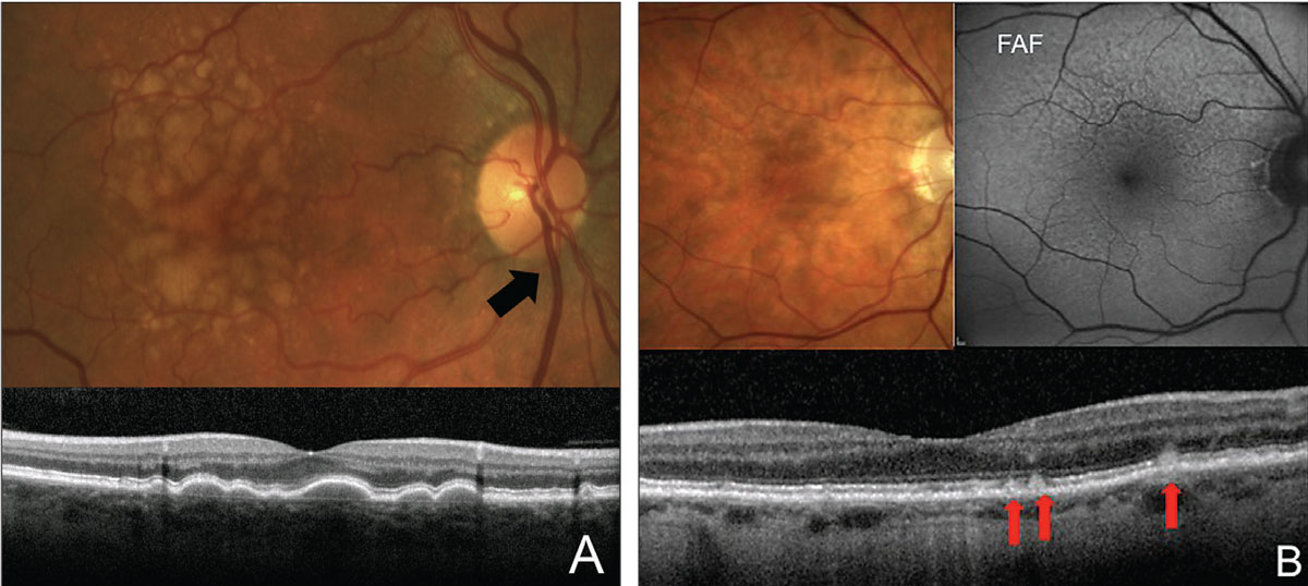 Fig. 6. Look out for the following clinical findings: large soft drusen (A) and RPD (B). Soft drusen are the width of a major retinal vein as it crosses the disc (black arrow). RPDs are more evident on FAF and OCT. On OCT, they present as hyper-reflective deposits on top of the RPE (red arrows).