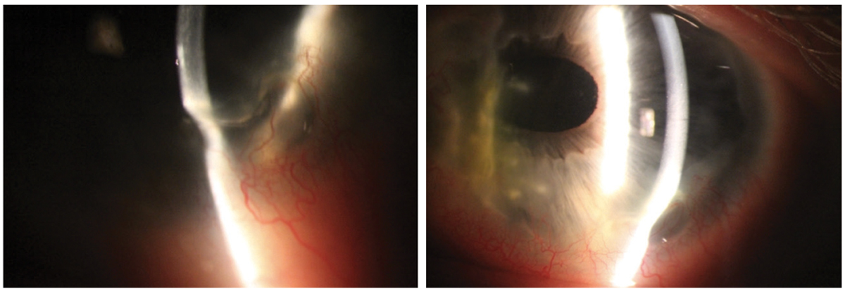 PUK in a 47-year-old white male. This patient had a history of prior perforation requiring a patch graft, which can be viewed on the nasal cornea. The cornea shows 70% thinning infratemporally with significant neovascularization. He required treatment with oral prednisone, slowly tapered over many months, and cyclophosphamide administered by a rheumatologist.