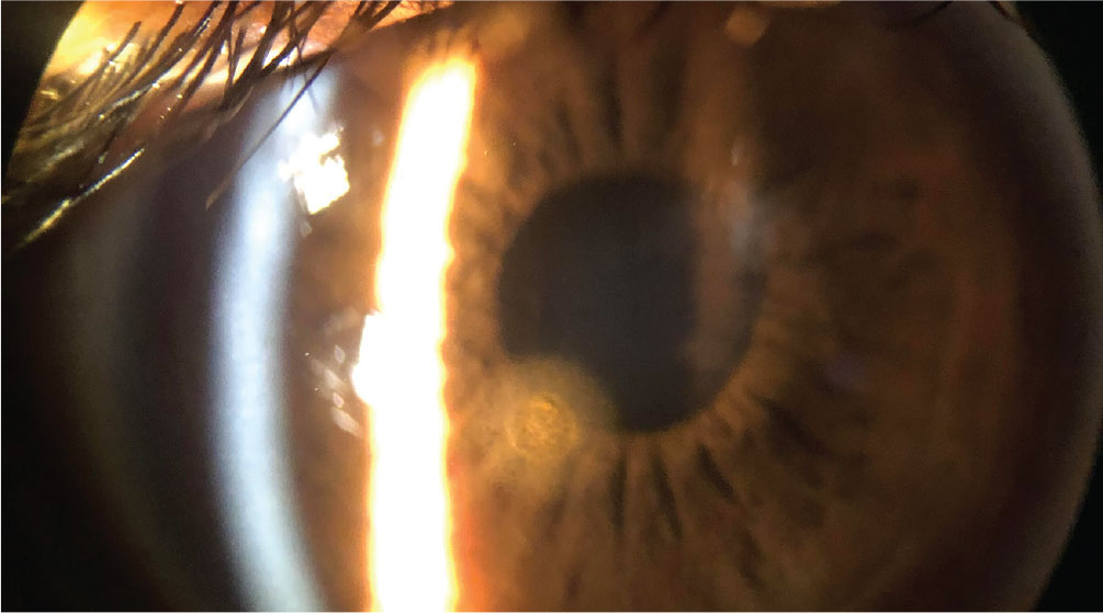 Foreign body cases are one area where it’s crucial for optometrists to take the lead in initiating urgent care to the full extent of their skills and scope of practice. This is a patient’s cornea immediately after removal of a metallic foreign body but prior to rust ring removal. The object was superficial enough that it was removed with a sterile cotton swab after anesthetizing the patient’s eye.