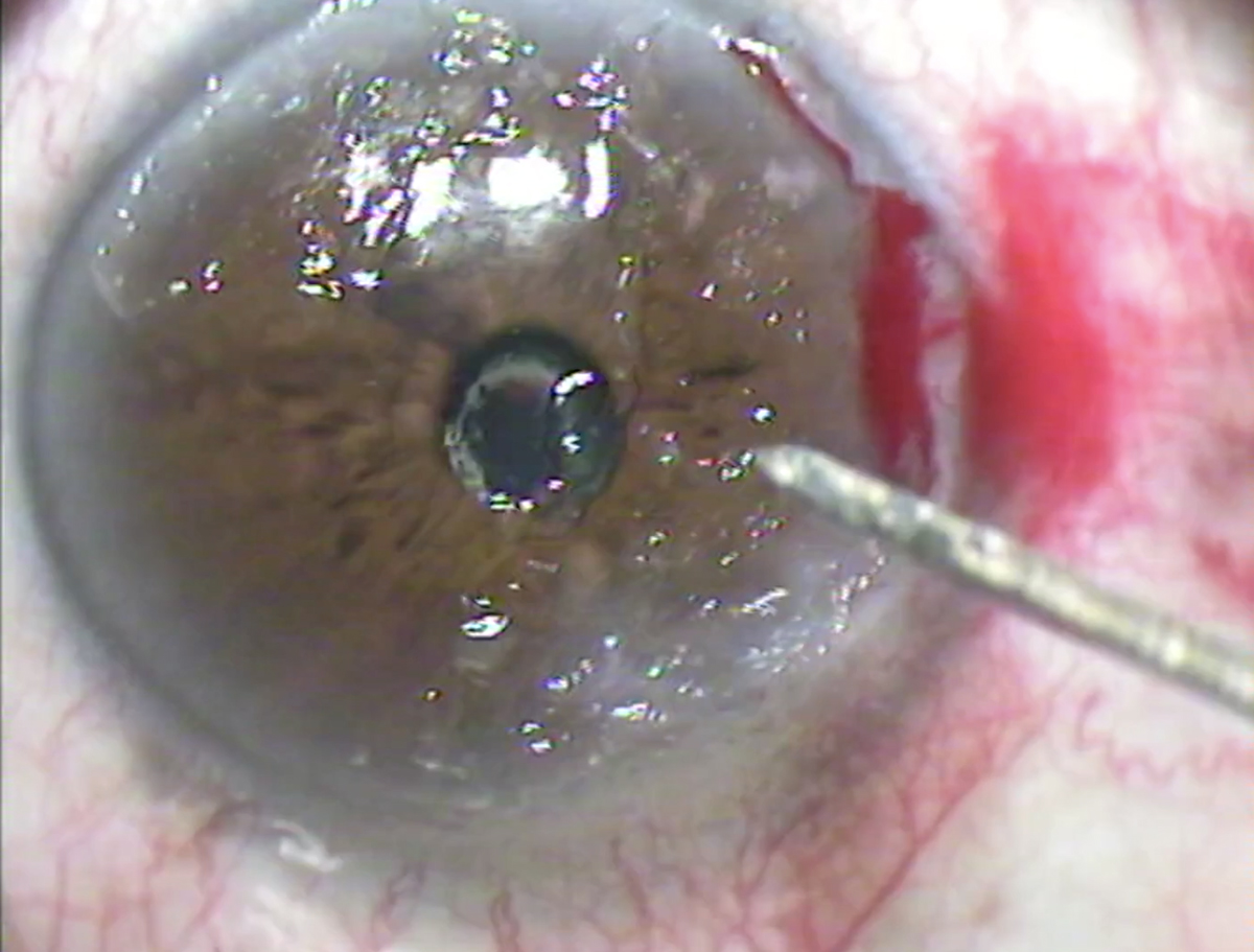 Superficial keratectomy involves the manual removal of superficial corneal scar tissue.
