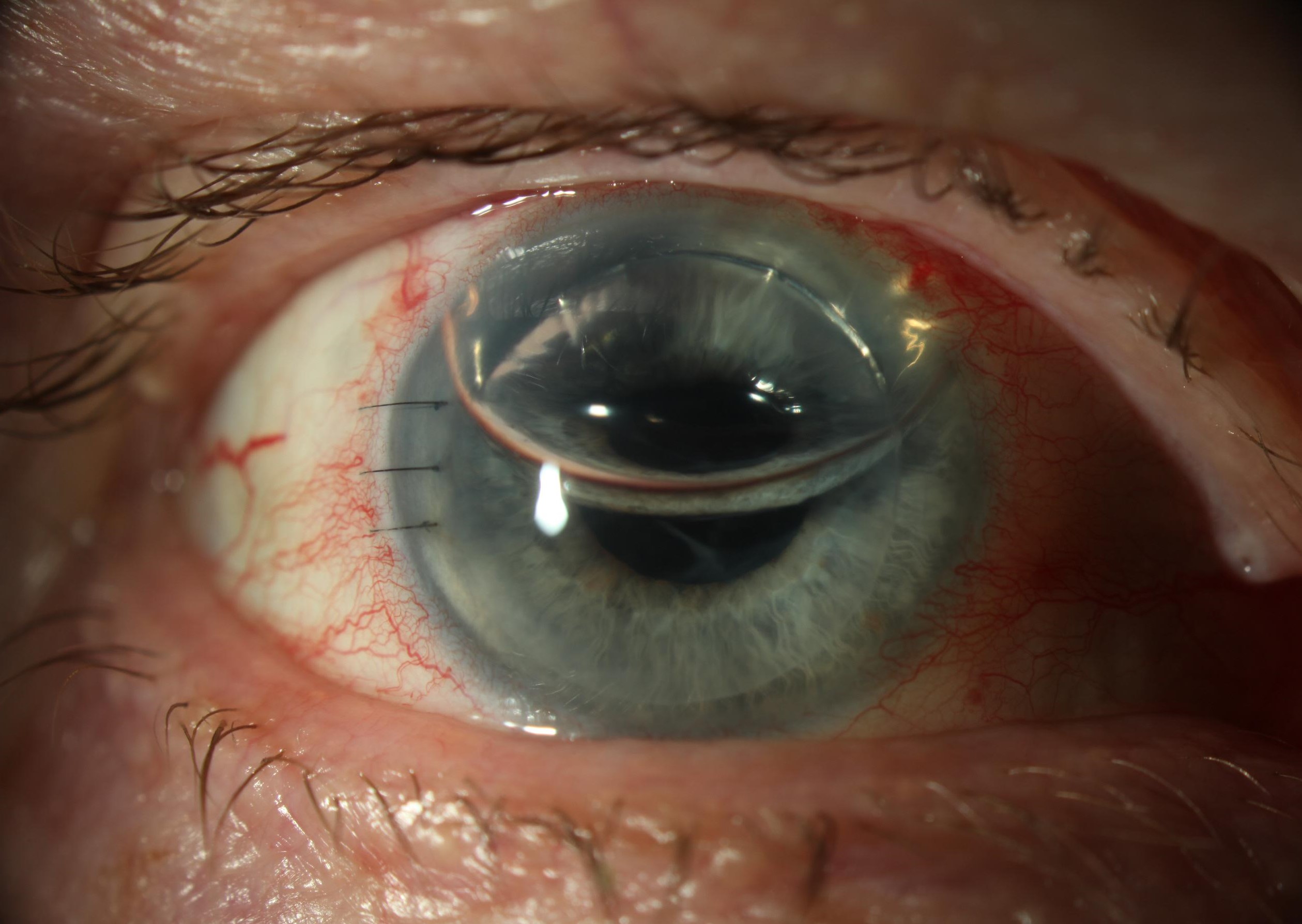 This is a patient one day post-DSAEK. For both DSAEK and DMEK, the transplants are supported by the air bubble in the anterior chamber. Both transplant types require supine positioning that can be difficult for people with spinal problems, and they suffer from periodic early dislocation of the graft, but in this case the eye and transplant are healing well.
