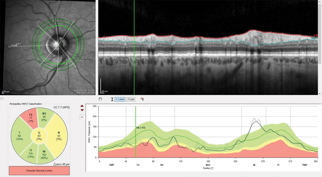 Here’s an overview of the three areas to observe when monitoring for disease progression: the neuroretinal rim, circumpapillary RNFL and macular region. Existing damage in this case can be readily seen in both the macular ganglion cell layer and the superior temporal RNFL.