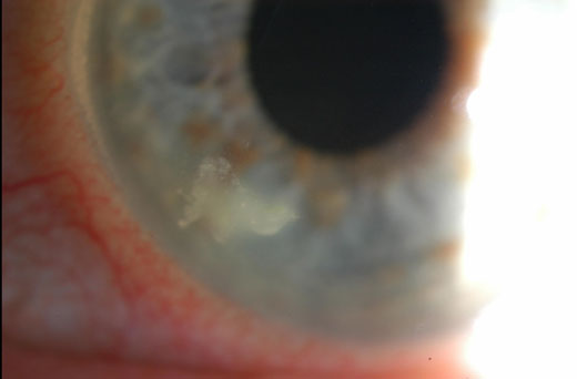 This patient developed bacterial keratitis from sleeping in their contact lenses.