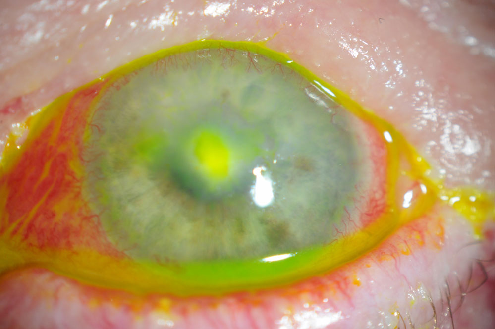 This 56-year-old female had a persistent epithelial defect secondary to trichiasis (caused by squamous cell carcinoma lid surgery). She wore a bandage contact lens for pain and developed an ulcer.