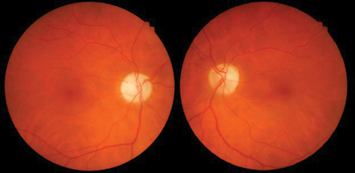 Fig. 3. Interferon retinopathy with cotton wool spots.