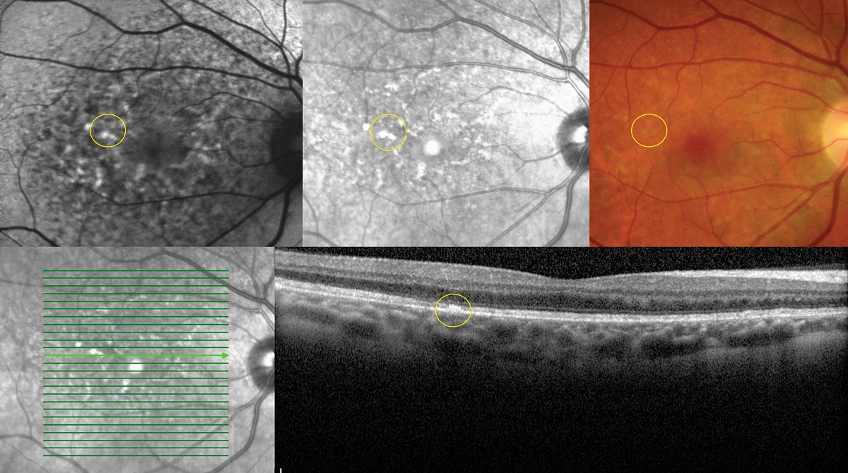 Fig. 5. Multimodal imaging demonstrating collocated yellow deposits, RPE thickening, near infrared hyper-reflectance and hyperAF on FAF imaging in advanced Elmiron maculopathy.