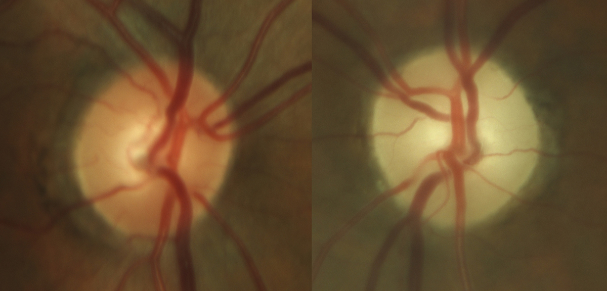 Fig. 6. Late stage, severe optic atrophy OS in a patient on chronic amiodarone therapy.