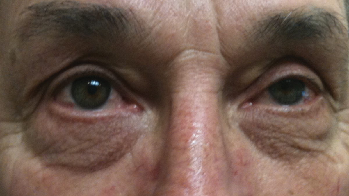 As many as 60% of myasthenia gravis patients, such as this one, present with ptosis and diplopia.