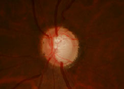 Glaucomatous optic nerve.