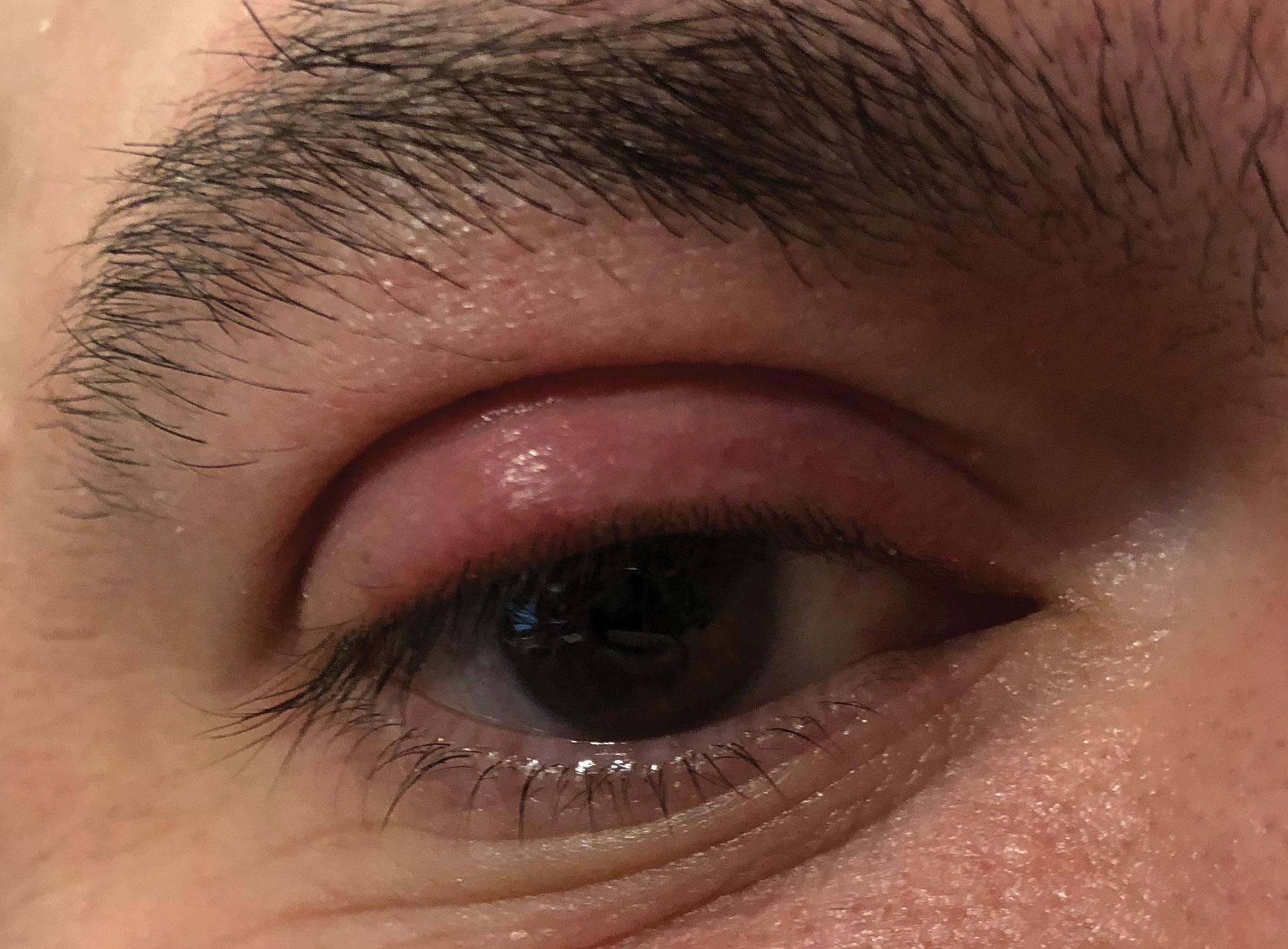This internally pointed hordeolum of the upper eyelid may respond well to topical ointments and hot compresses.
