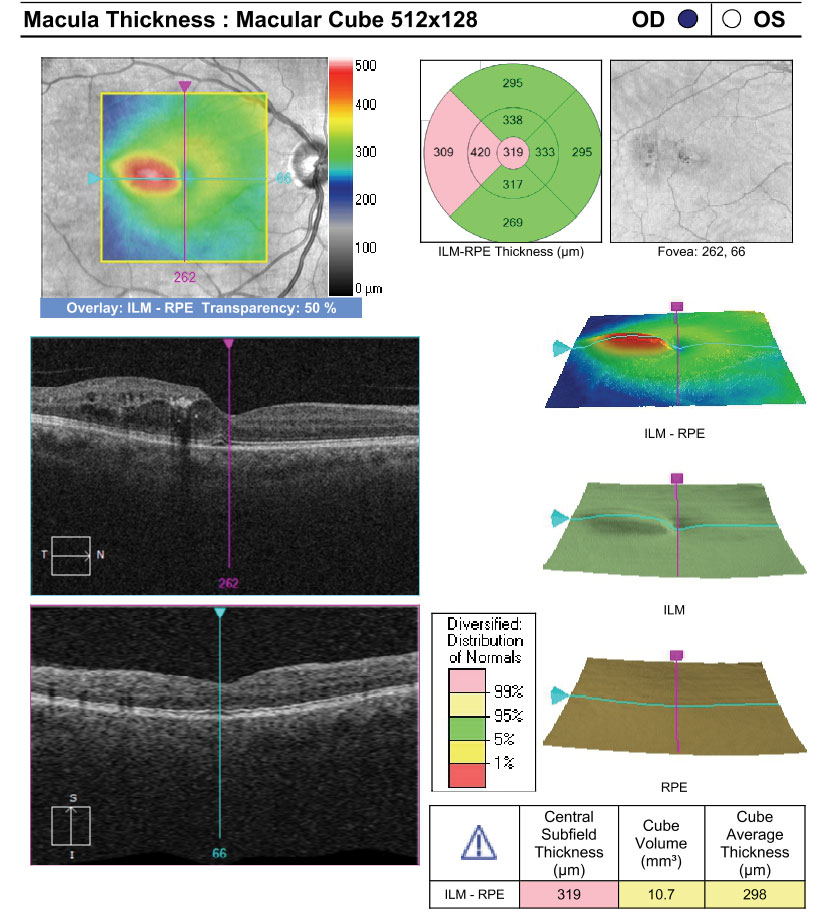 Fundus images and OCT of a patient with moderate NPDR OU and CI-DME OD. The patient’s best corrected acuities were 20/25 OD and 20/20 OS. The comanaging retina specialist elected to monitor the CI-DME OD based on the findings of DRCR Protocol V.