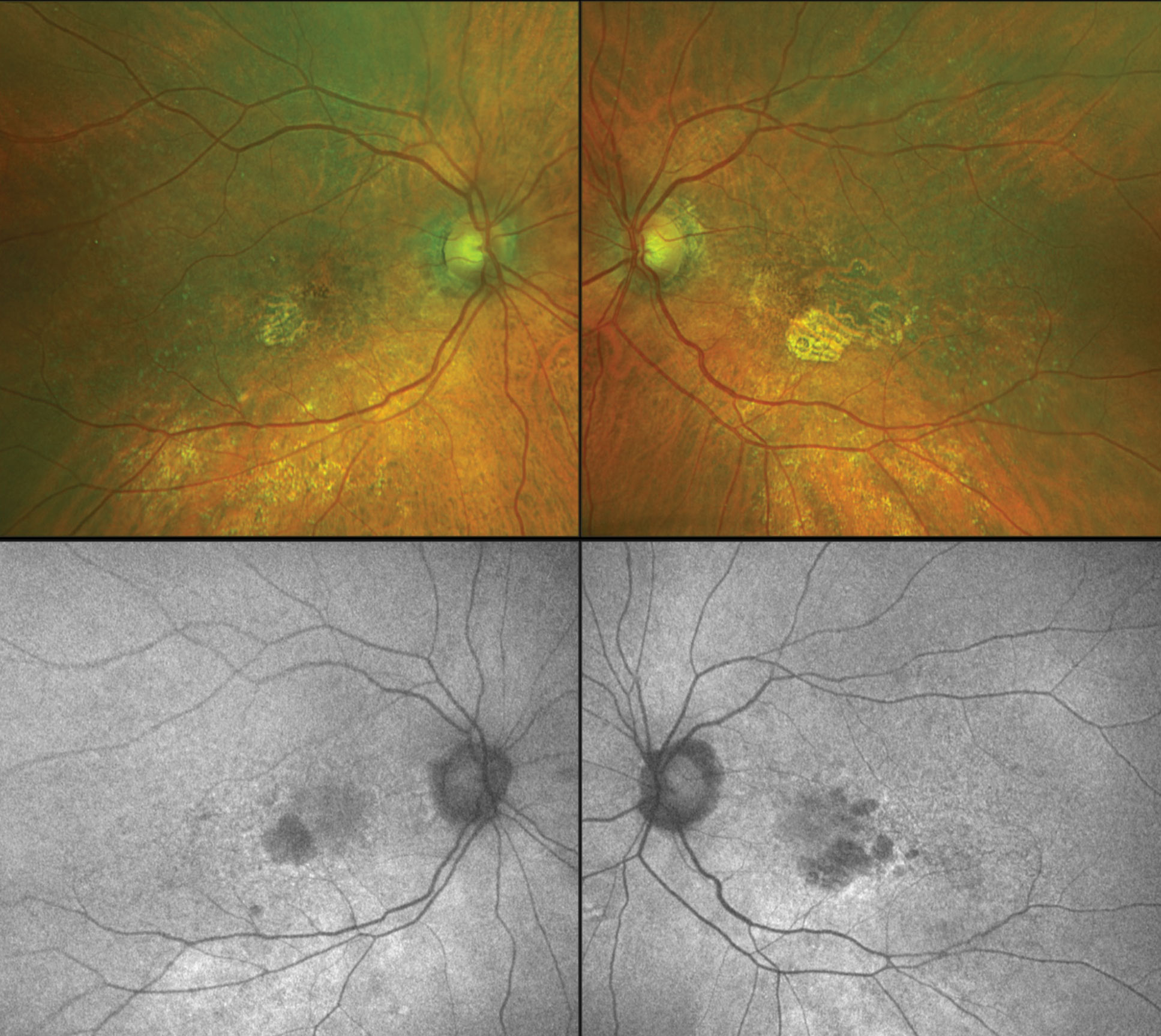 Color fundus images (top) and fundus autofluorescence (bottom) of a patient with geographic atrophy (GA) from macular degeneration OU. The SAGA study is exploring modified vitamin A treatment for GA patients such as seen here.