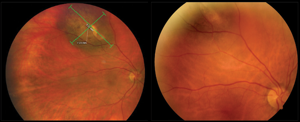 Comparing images from 2020 (left) and 2018 (right) of the pigmented choroidal tumor of the right eye demonstrates obvious expansion of the choroidal melanoma.