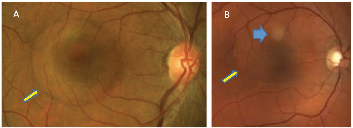 Fig. 1. In patients with acute CSCR, serous retinal detachment can be seen (yellow arrows). PED is not clinically detected in patient A but can be seen in patient B (blue).
