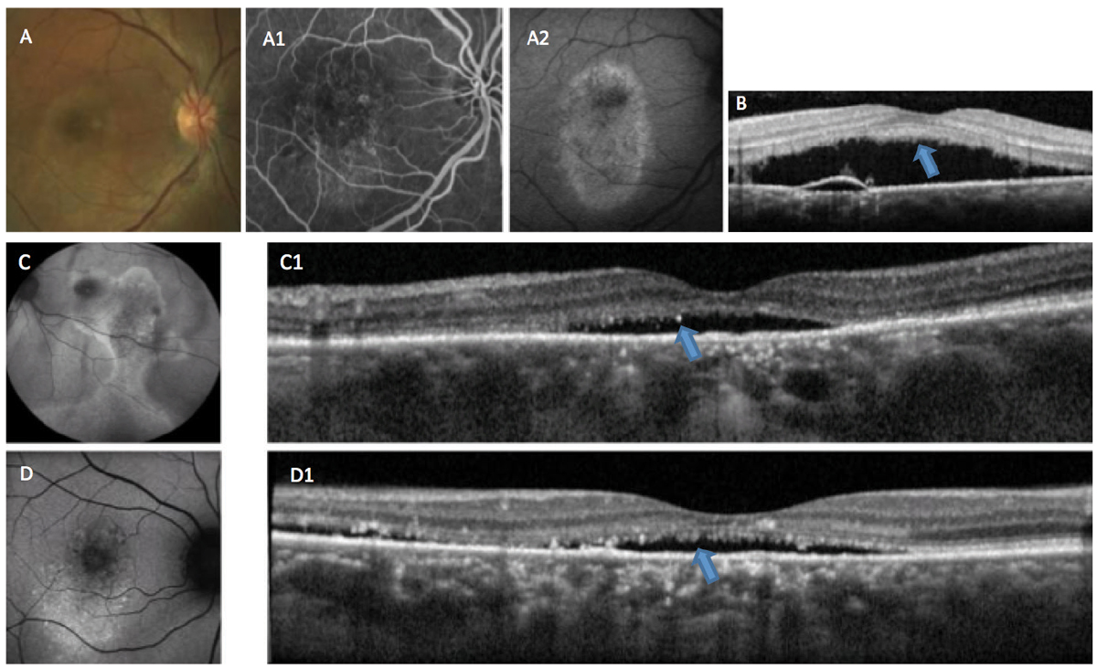 Fig. 3. This patient is suffering from chronic CSCR. In (A), RPE changes can be seen in the macula. Fluorescein angiography (A1) shows staining of the altered RPE, and fundus autofluorescense (A2) shows hyper-autofluorescence indicative of RPE damage. OCT (B) shows accumulation of RP outer segment shedding (“shaggy” photoreceptors), a phenomenon associated with choroidal melanomas (blue arrow). Autofluorescence (C and D) in other cases shows a variable mix of autofluorescence associated with chronicity and recurrence. OCT (C1 and D1) shows adverse alteration of the outer retina (blue arrows).