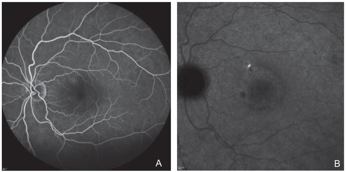 Fig. 8. Localized area of leakage on fluorescein angiography in (A) and ICGA in (B).