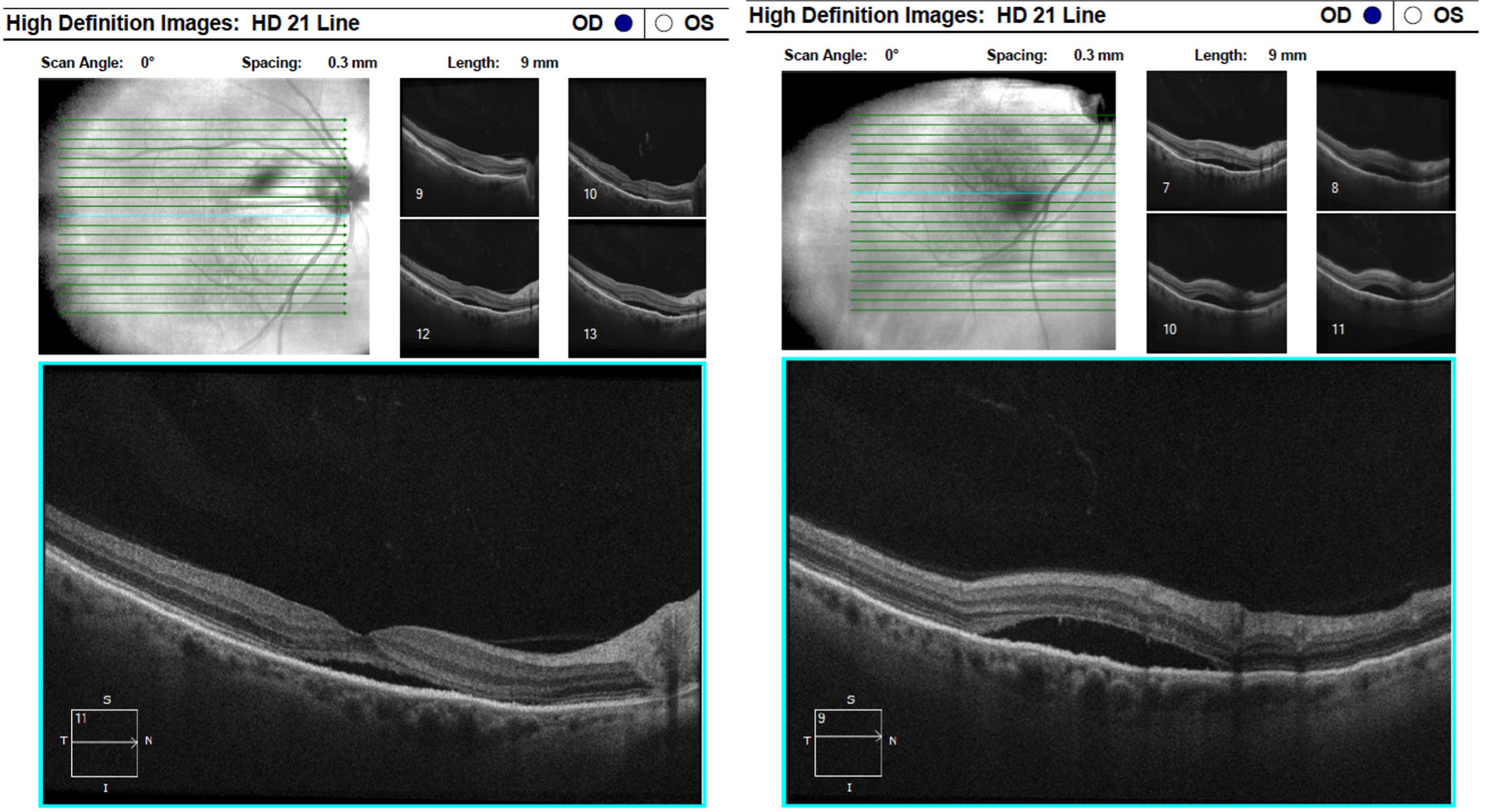 Figure 3 (Left) and Figure 4 (Right):  OCT raster images through the macula and the inferior arcade demonstrate extensive subretinal fluid with elongated, “shaggy” photoreceptors and outer retinal atrophy.