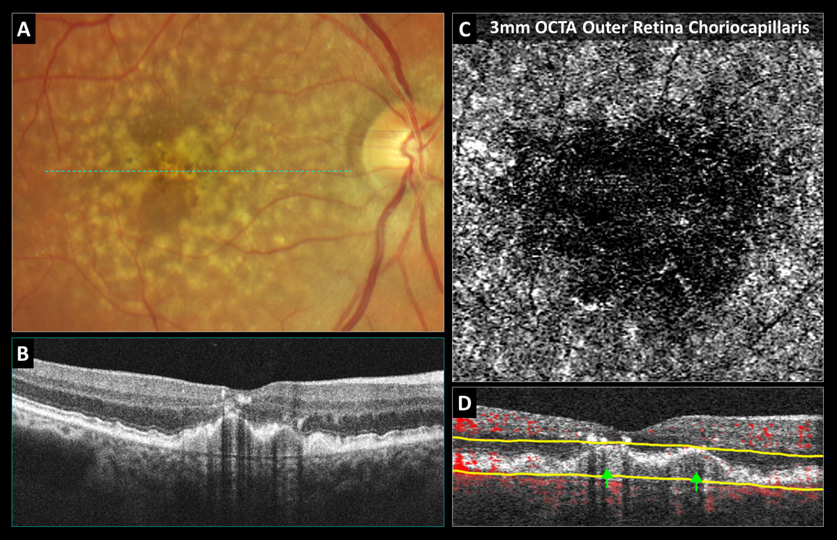Fig. 1. OCT-A confirms avascularity of a drusenoid pigment epithelial detachment (PED): (A) Color photo shows soft coalesced drusen with overlying hyperpigmentary changes. (B) Structural OCT reveals a PED with medium uniform internal reflectivity, no fluid and shadowing artifacts from the overlying intraretinal pigmentary migration. (C) 3mm OCT-A outer retina choriocapillaris enface display shows choriocapillaris nonperfusion without neovascularization. (D) OCT-A B-scan overlay with yellow segmentation boundaries reveals no red blood flow overlay internally within the PED.