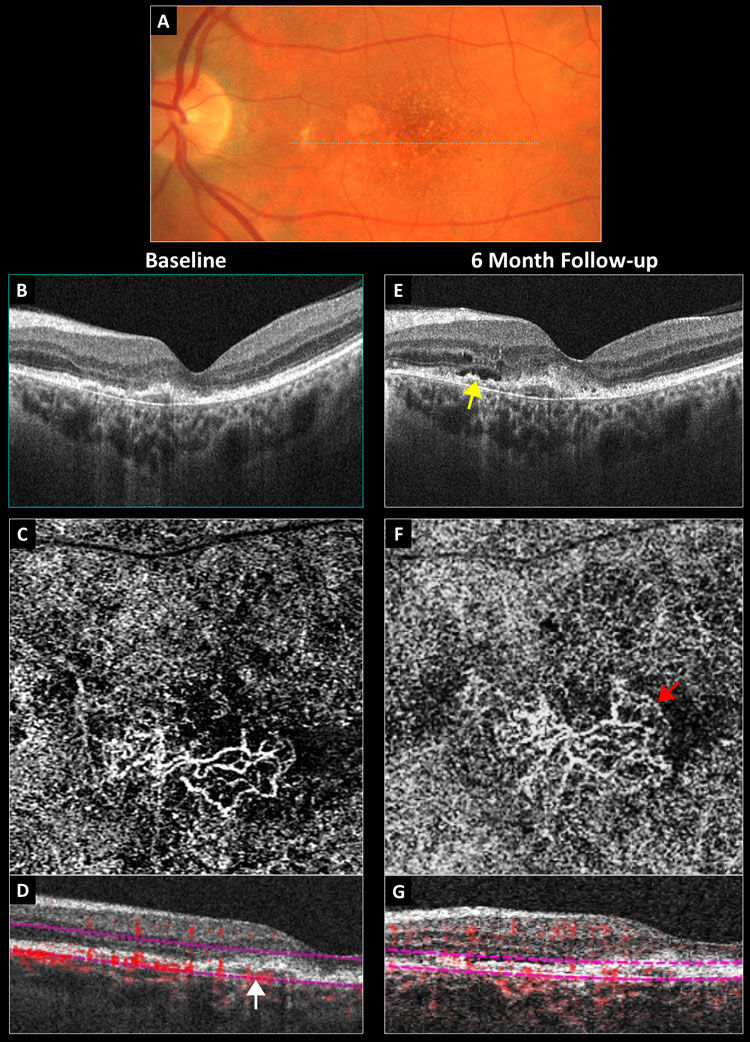 Fig. 2. Conversion of a non-exudative neovascular membrane to exudative AMD: (A) baseline color photograph, (B) baseline structural OCT, (C) baseline 3mm OCT-A outer retina choriocapillaris en-face display, (D) baseline OCT-A B-scan overlay with the white arrow pointing to a vascularized PED, (E) six-month structural OCT with the yellow arrow pointing to new subretinal fluid, (F) six-month 3mm OCT-A with the red arrow pointing to a peripheral fringe of lacy capillaries and (G) six-month OCT-A B-scan overlay.
