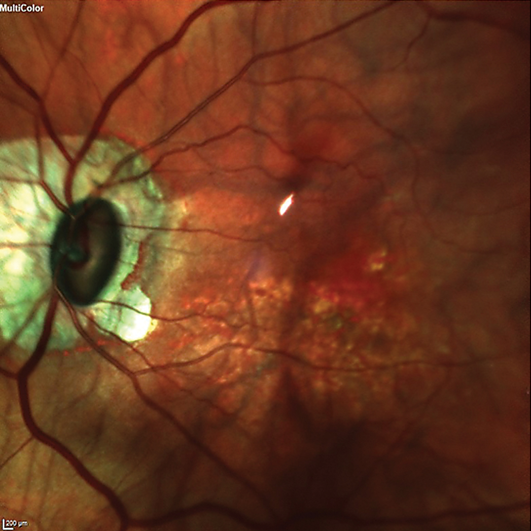 The patient’s left eye demonstrated an oblique insertion of the optic nerve, along with macular changes and thinning of the neuroretinal rim.