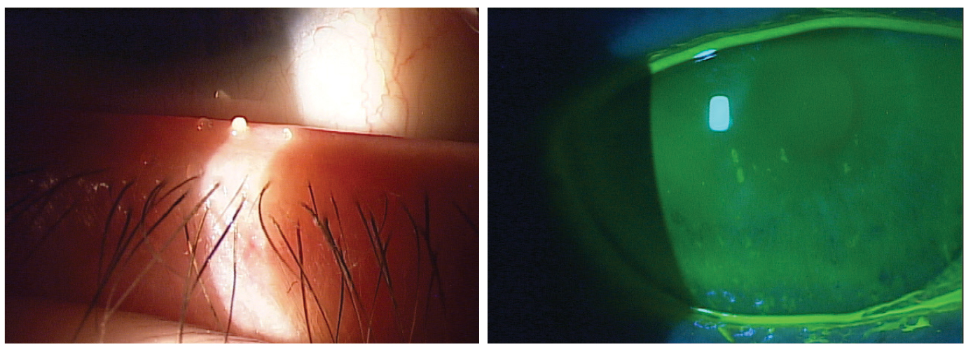 Evaporative DED, a consequence of MGD (left),  and aqueous-deficient (right) and are the two primary types of dry eye.