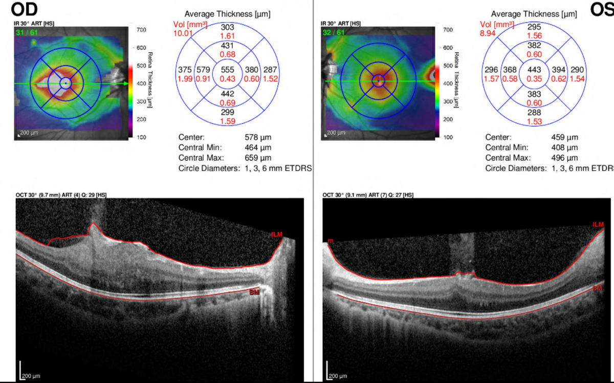 Fig 3. Optical coherence tomography with macular thickness map of the right and left eye.