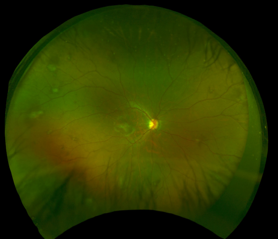 Fig. 1. Fundus photograph of the right eye captured with Optos.