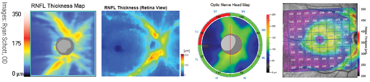 Understanding the fundamentals of OCT use in glaucoma is now an essential part of care and greatly extends the OD’s ability to manage cases themselves prior to referral. Shown here are four RNFL thickness maps of the same patient on different platforms, from an analysis Review of Optometry published in February 2020; it can be found on the website.  From left to right: Zeiss Cirrus 6000, Topcon Maestro2, Optovue Avanti, Heidelberg Spectralis.