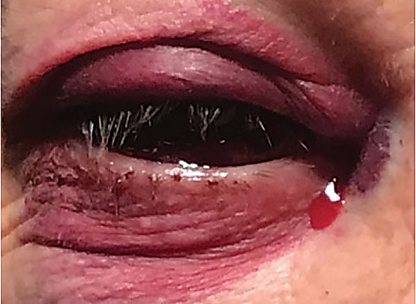 Fig. 1. Ecchymosis of the upper and lower eyelids. Note the blood mixed in with the tears in the medial canthal area.