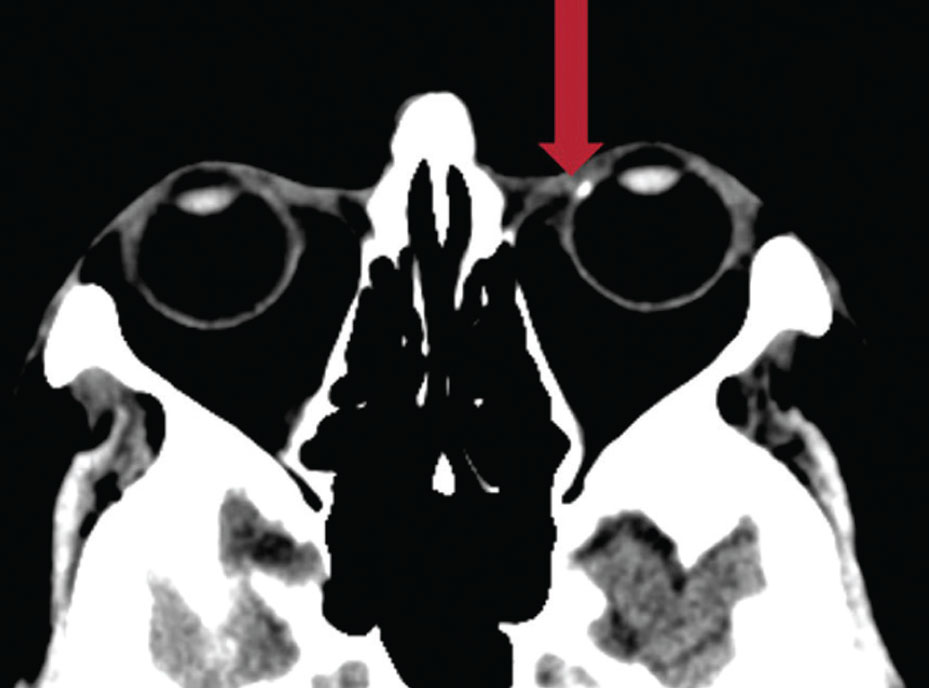 Corneal arcus appears hyper-dense on CT scans (red arrow). 