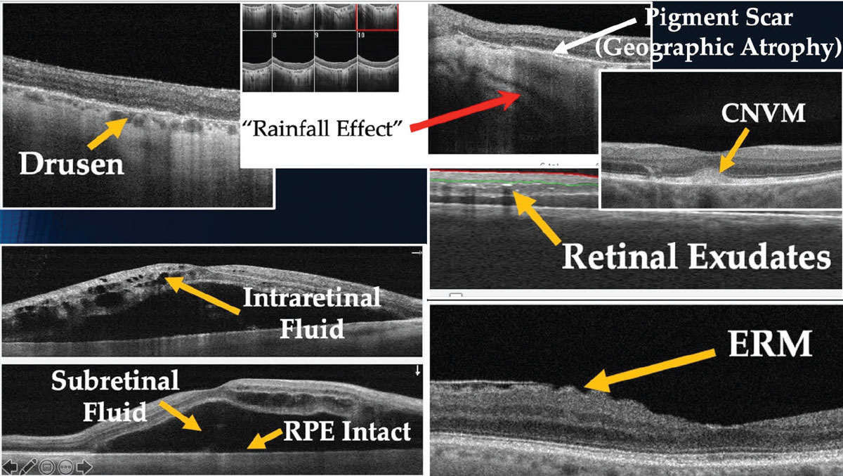 OCT Interpretation For Glaucoma Don t Get Fooled 2022 