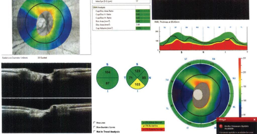 Fig. 2. A normal tension glaucoma suspect’s RNFL scan of the ONH. The data is reliable and grossly normal, with the exception of the inferior RNFL pie chart thickness. 