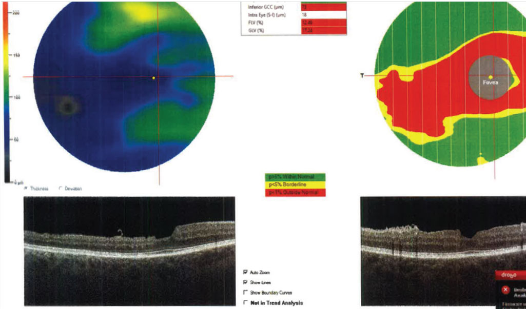 Fig 3. The GCC analysis of the macular region on the same patient as Fig. 2, taken on the same day. Results are reliable and indicated significant GCC thinning in the macular region.