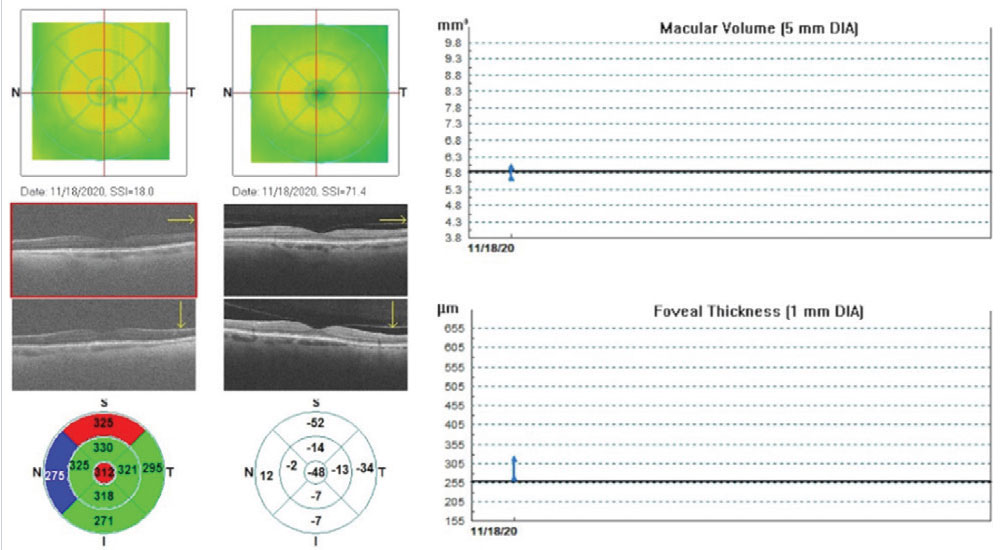 Fig. 5. Optovue retinal map change analysis of a patient with grade 3 PCO immediately pre- and post-YAG capsulotomy. Significant improvement in image resolution was obtained, demonstrating artifactual changes in macular volume and foveal thickness and decreased average RNFL thickness, compared with the same eye correctly imaged on the right. 