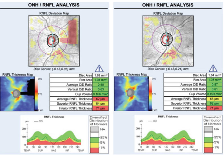 Fig. 7. Truncation artifact: structures being imaged (in this case the optic nerve/RNFL) are only partially included in the acquisition frame in the left image. Superior nasal loss of data results in incorrectly assumed thinning of the superior RNFL and a decrease in the average RNFL thickness compared with the same eye correctly imaged on the right. 