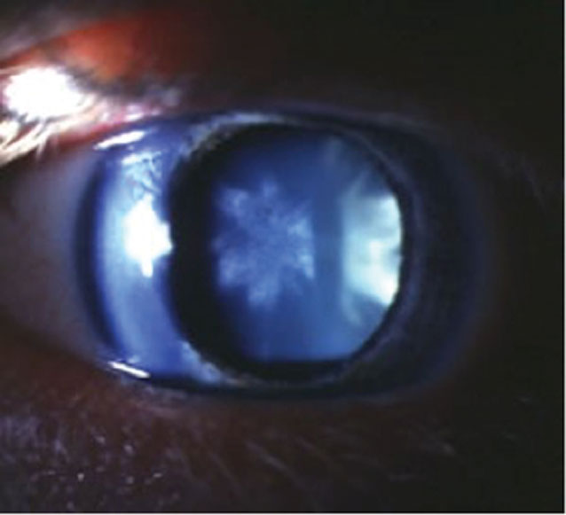 Rosette lens opacity post-trauma may permanently affect best-corrected VA and is an indication for assessment of other traumatic complications in the eye.