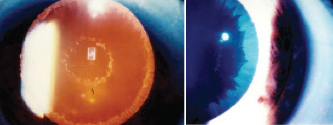 PXE material on the lens surface can be seen on retroillumination (A) and with white light (B).