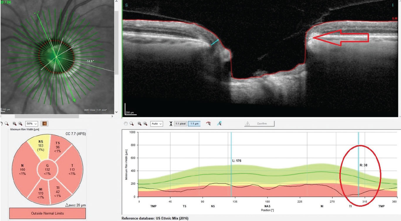 Significant thinning in the neuroretinal rim OS. Inferotemporally, Bruch’s membrane opening is reduced to less than 38µm (circle and arrow).