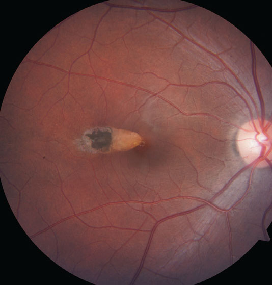 Outer retinal changes on the OCT are apparent in the location of the torpedo lesion (here).