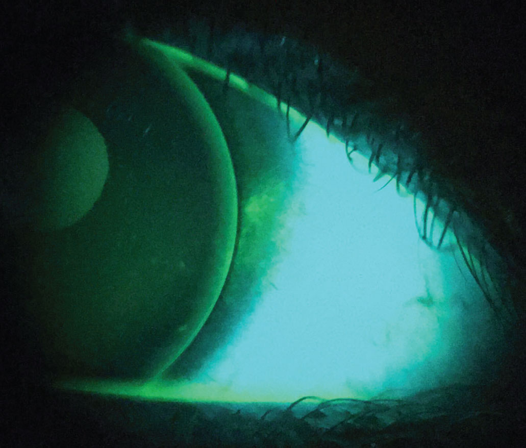 Fig. 5. Punctate staining present along the edge of a corneal GP lens characteristic of “3 and 9 o’clock” staining.