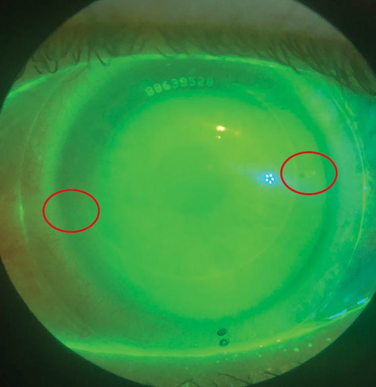 Fig. 1. This scleral has toric haptics. The flat meridian is denoted by hashmarks, which are rotated 15⁰ counterclockwise.
