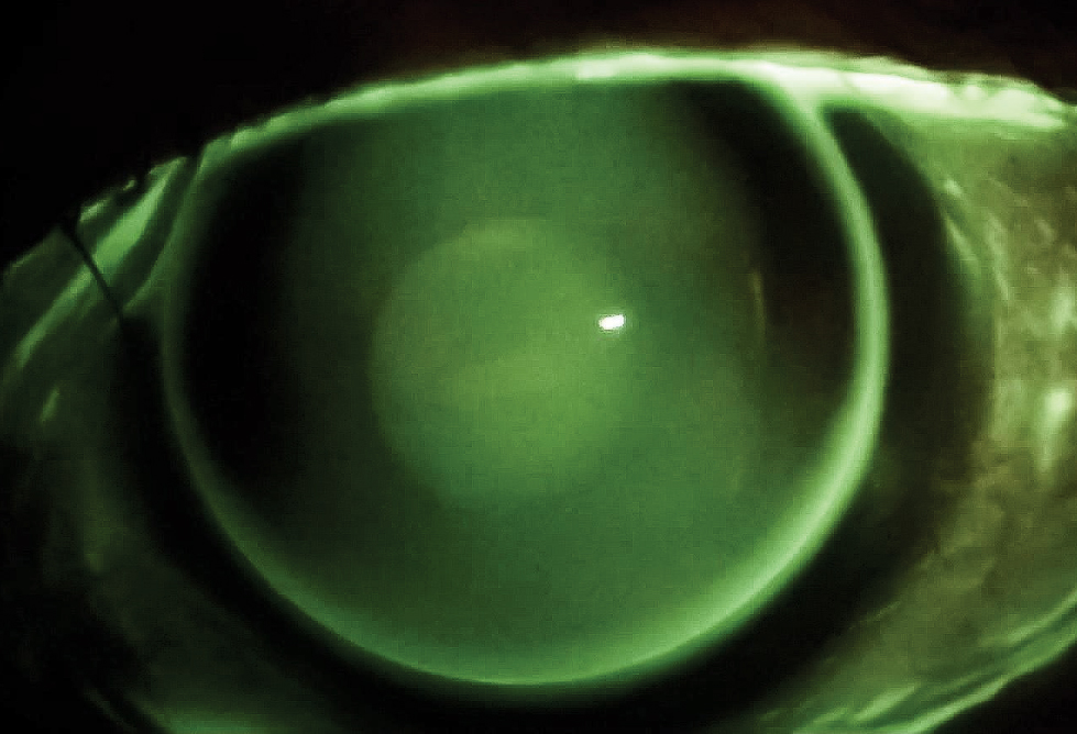 Fig. 2. Evaluation revealed a high-riding, lid-attached fit. There was a dumbbell-shaped fluorescein pattern with pooling in the vertical meridian and bearing in the horizontal indicative of WTRA. This is how a spherical GP looks on a toric cornea.