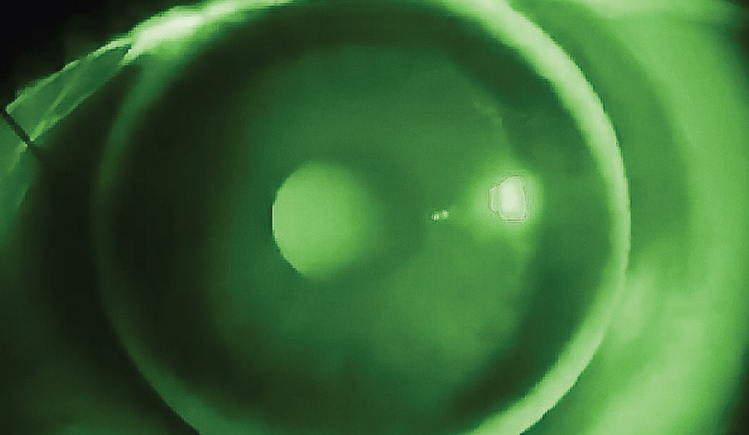 Fig. 5. A well fit bitoric GP on a toric cornea will have an alignment fluorescein pattern comparable to a spherical GP.