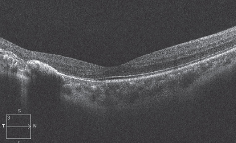 Outer retinal changes on the OCT (here) are apparent in the location of the torpedo lesion.