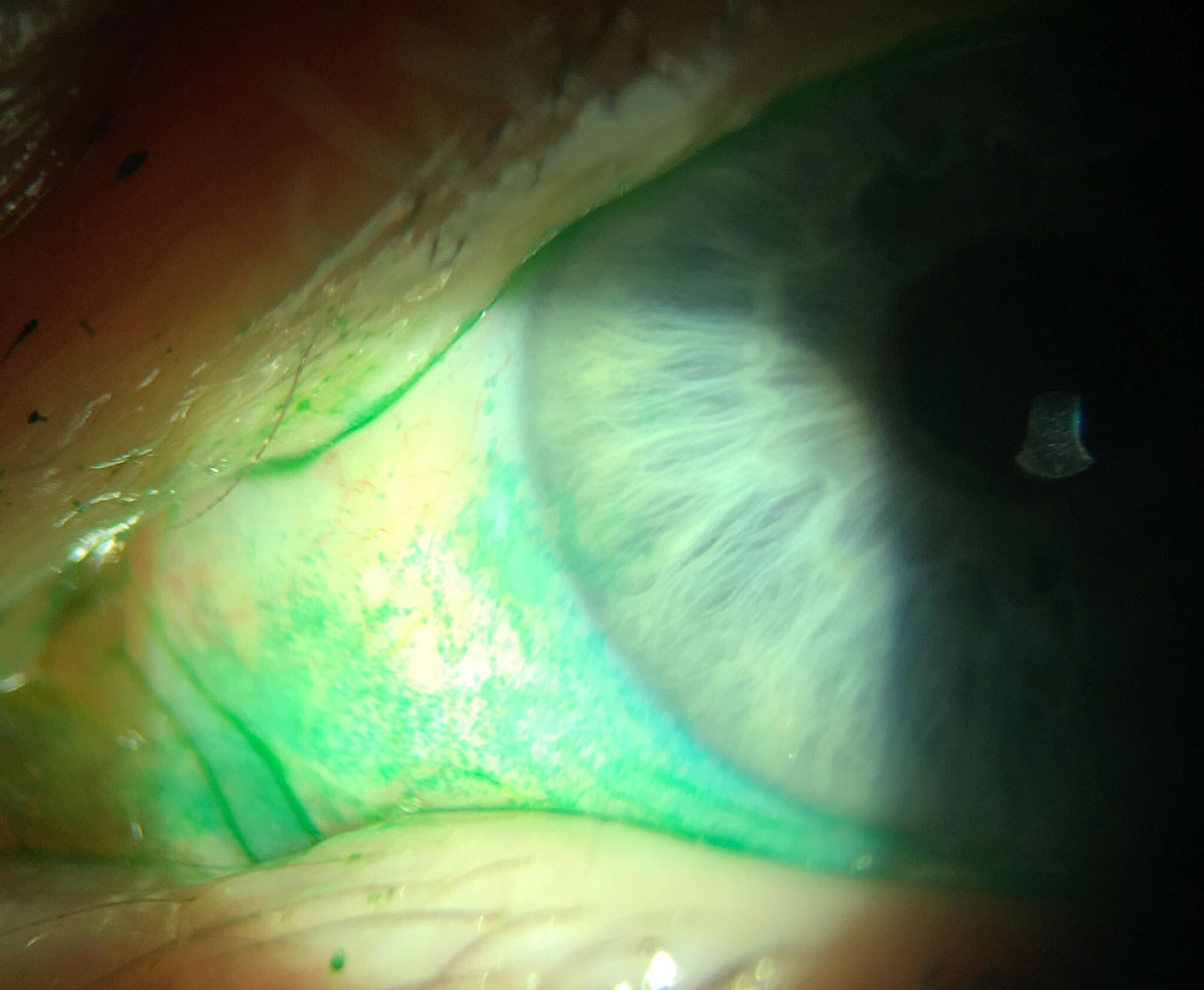 Fig. 4. Bulbar conjunctival staining with lissamine green (here) and palpebral conjunctival staining characteristic of mild LWE.