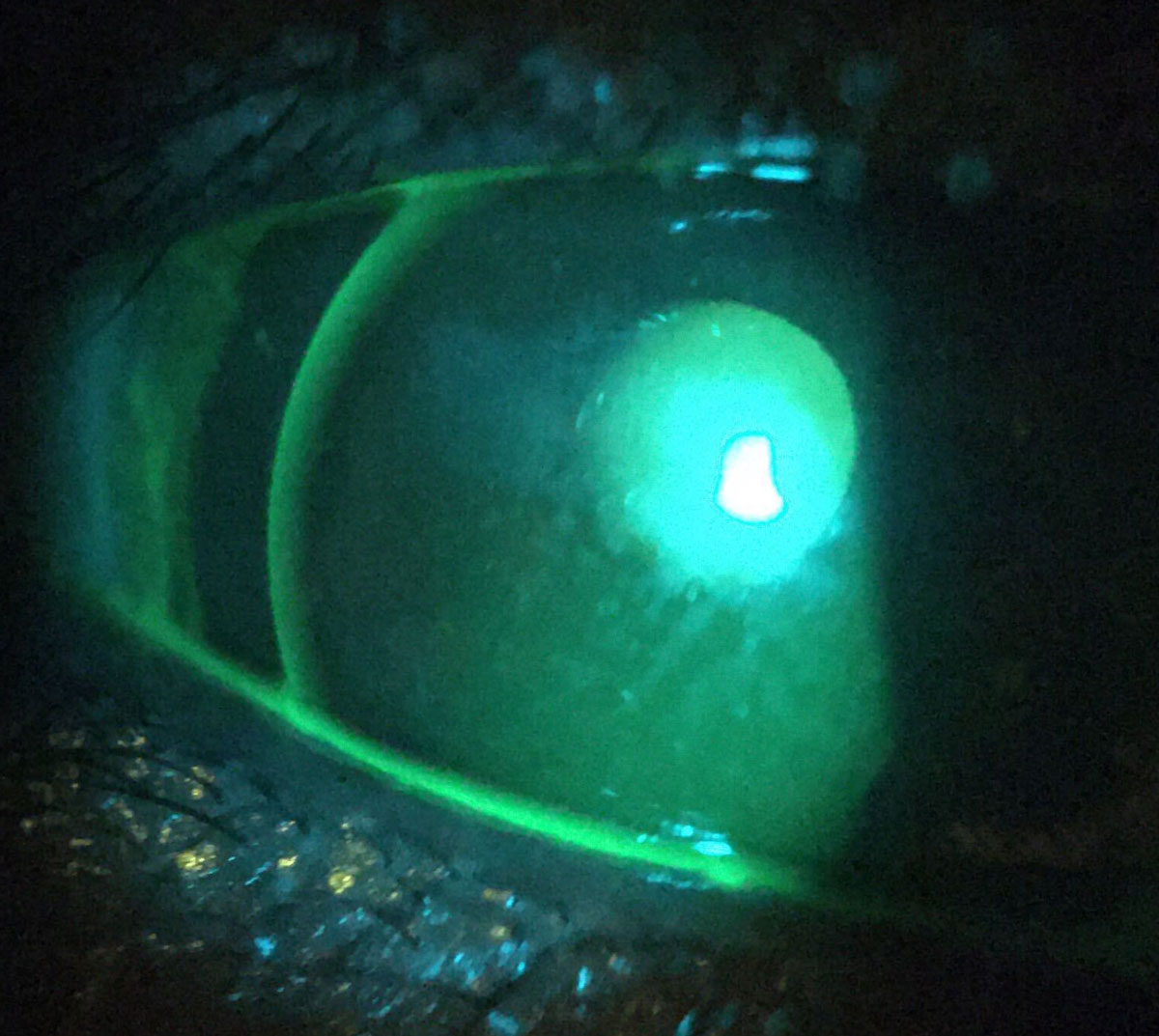 Fig. 3. Sodium fluorescein staining demonstrates front surface tear film break-up in this GP lens patient.