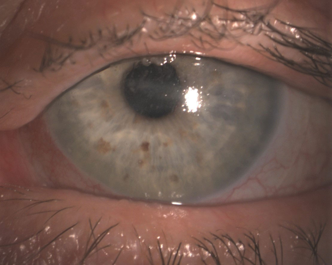 Fig. 2. A scleral lens evaluated with white light that demonstrates poor surface wetting and mucus build-up on a patient with neurotrophic keratitis.