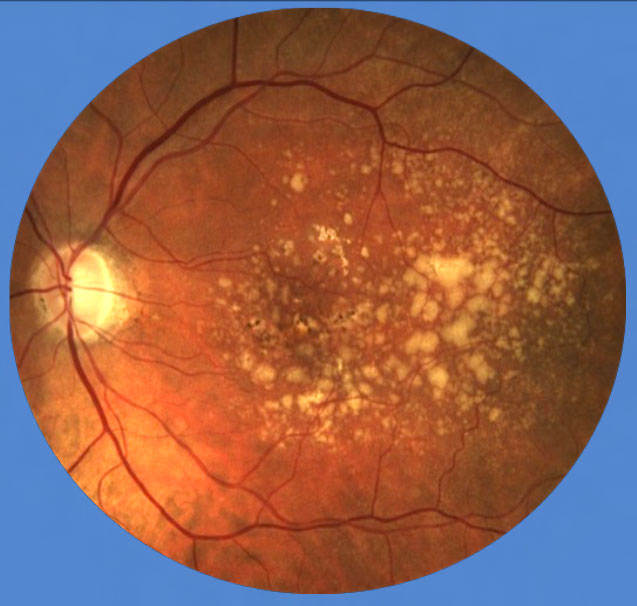 Of all evaluated methods of detecting nAMD in a fellow eye, OCT proved most effective. Image courtesy of Mohammad Rafieetary, OD. 